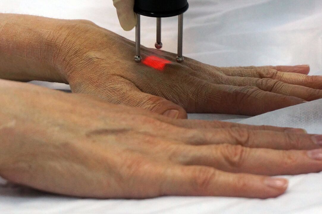 Peremajaan tangan dengan laser dengan metode non-ablatif