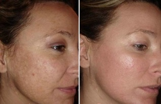 laser peremajaan kulit wajah sebelum dan sesudah foto